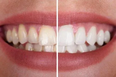 split image showing before and after results of professional teeth whitening, Greenacres, FL cosmetic dentistry Lake Worth, FL