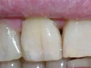 cracked tooth Mahwah, NJ