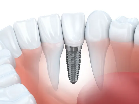 illustration of natural teeth in gums with embedded dental implants Somerville, MA