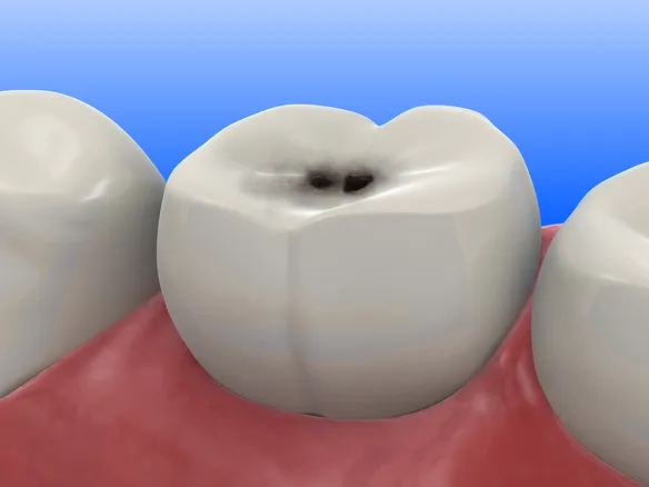 Tooth cavity needing dental filling, Brooksville FL