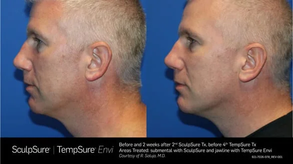 Profile Jawline TempSure Envi Before and After