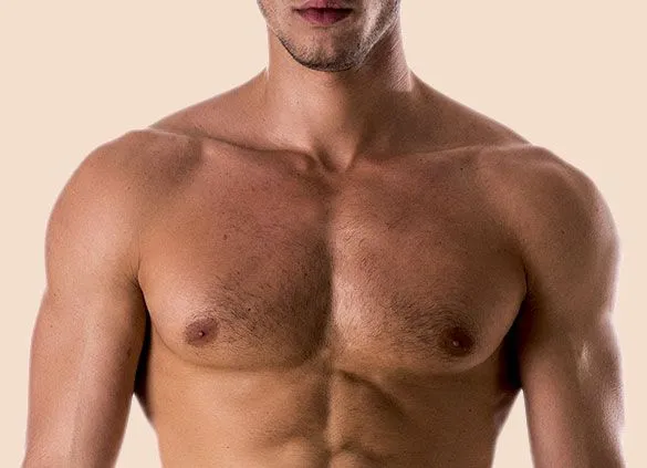 gynecomastia