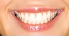 woman's smiling mouth, nice teeth, dental bonding from dentist Beverly Hills, MI