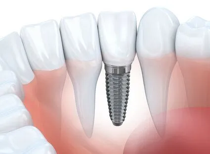 computer illustration of dental implant embedded into gums next to natural teeth, dental implants San Marcos, CA implant dentistry