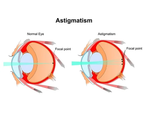 Astigmatism vs Normal Eye