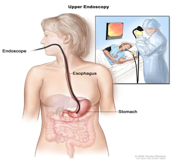 upper endoscopy