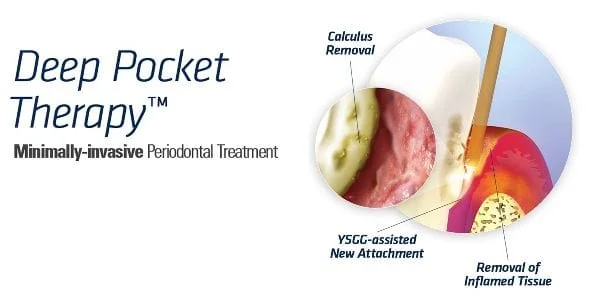 Deep Pocket Therapy - laser gum surgery Tustin
