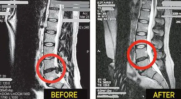 Spinal Decompression Therapy