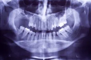 Sinus Augmentation