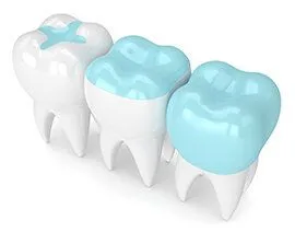 illustration of three teeth showing dental inlay, dental onlay and full crown - dentist Kanata, ON cosmetic dentistry