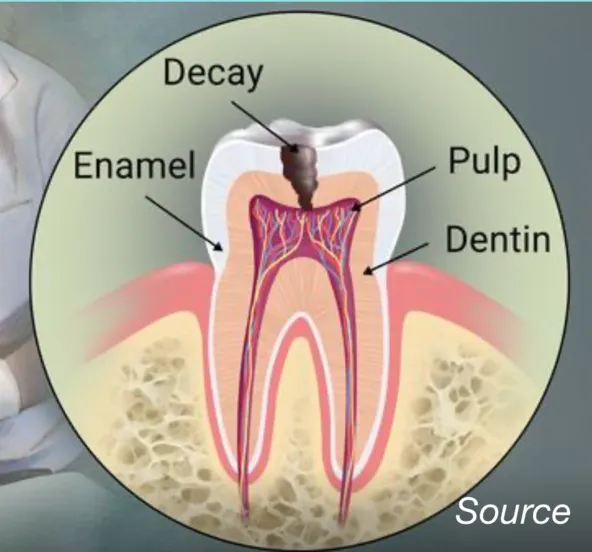 Dental Decay in Reston, VA