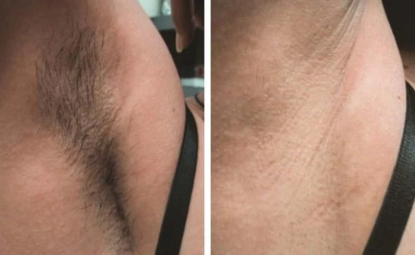 LASER HAIR REMOVAL
