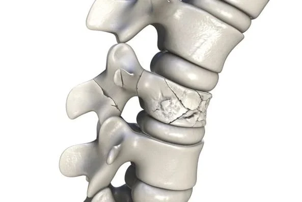 Medical illustration of a damaged joint