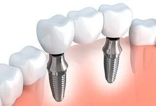 3D illustration of implant supported dental bridge being placed in mouth, dental bridges Acton, MA dentist