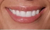 Close up photo of person smiling with Dental Crowns in Winter Garden, FL