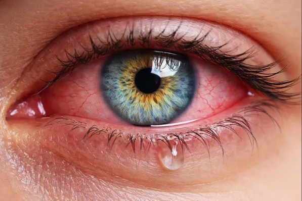 Dry Eye
