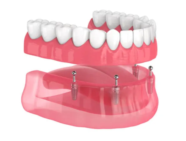 Implant denture