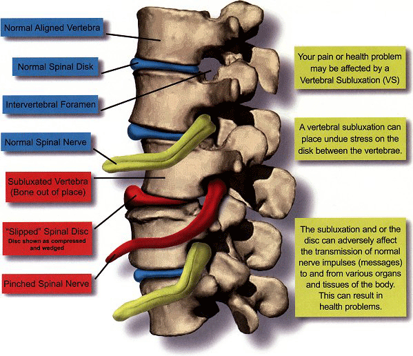 Spinal Vertebral Subluxation Complex