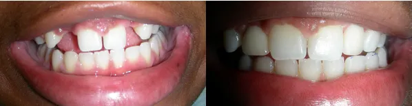 dental_implant4.png