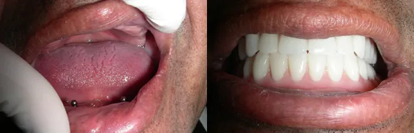 dental_implant7.png