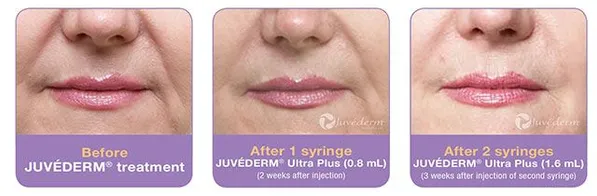 Before & After Juvederm