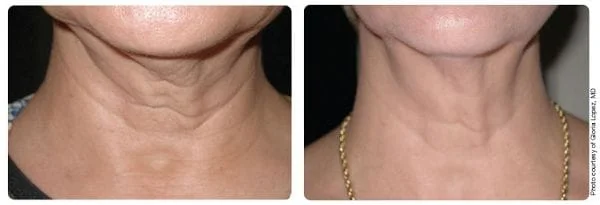 Skin Firming - Before and After 1
