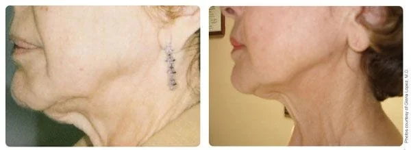 Skin Firming - Before and After 2