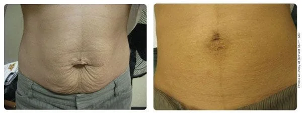Skin Firming - Before and After 3