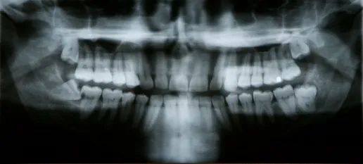 X-ray of teeth