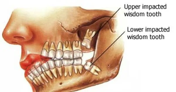 Illustration of impacted Wisdom Tooth for Extractions, Waterloo, ON