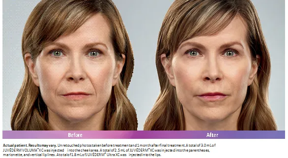 fillers Dermatologist in Santa Monica, CA