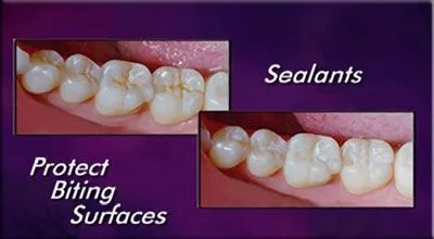 sealants