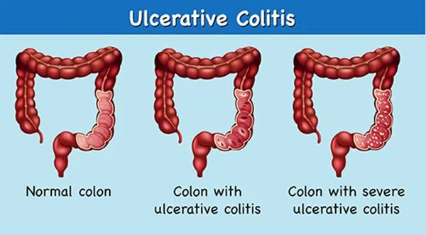 Ulcerative Colitis