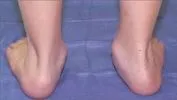 pediatric_flatfoot1.jpg