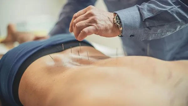 Acupuncture
