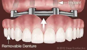 Support Removable Dentures with Lansing, MI dental implants