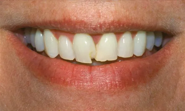 before veneers