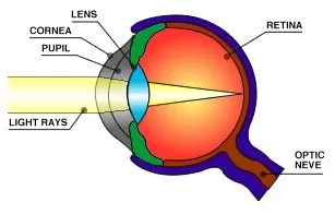 Glaucoma eye example