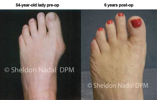 Before and After - Bunions/Bunionettes - Sheldon H. Nadal, D.P.M.