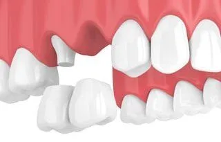3D illustration of cantilever dental bridge being placed in mouth, dentist Acton, MA dental bridges