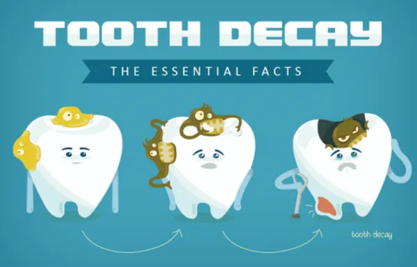 what is tooth decay