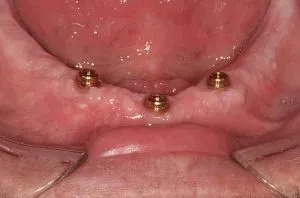 Biella Implants