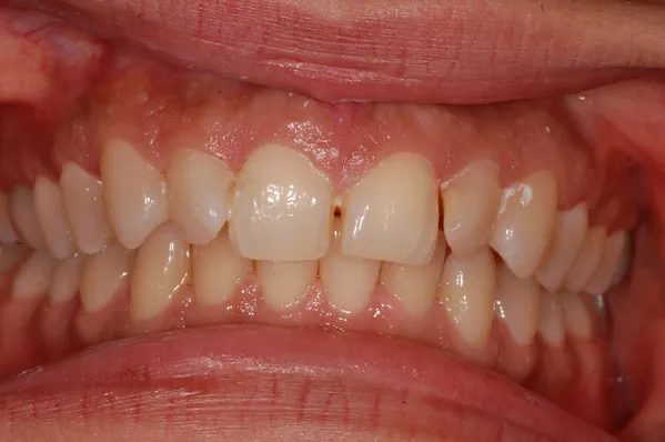 before crowns and veneers