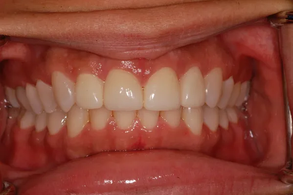 after crowns and veneers