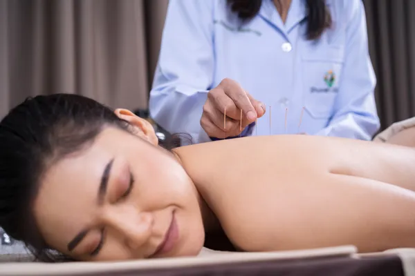 girl having acupuncture