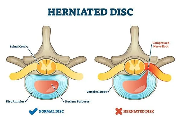 Side by side comparison of a normal disc and a herniated disc