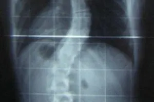 scoliosis_x_ray_200_300.jpg