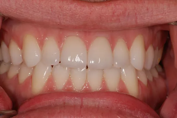 after cerec