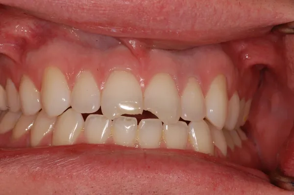 before cerec