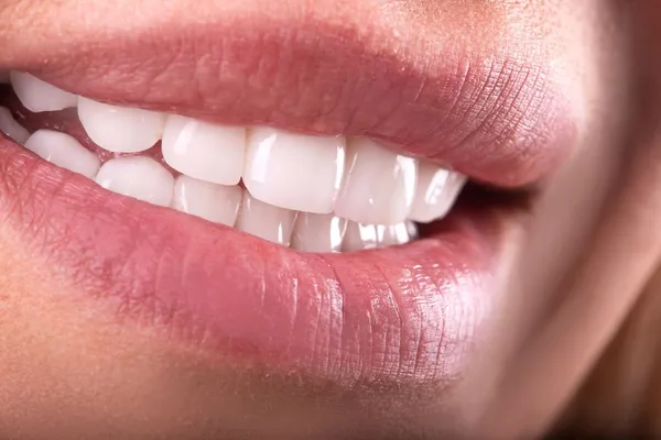 Teeth Whitening In Parker, CO